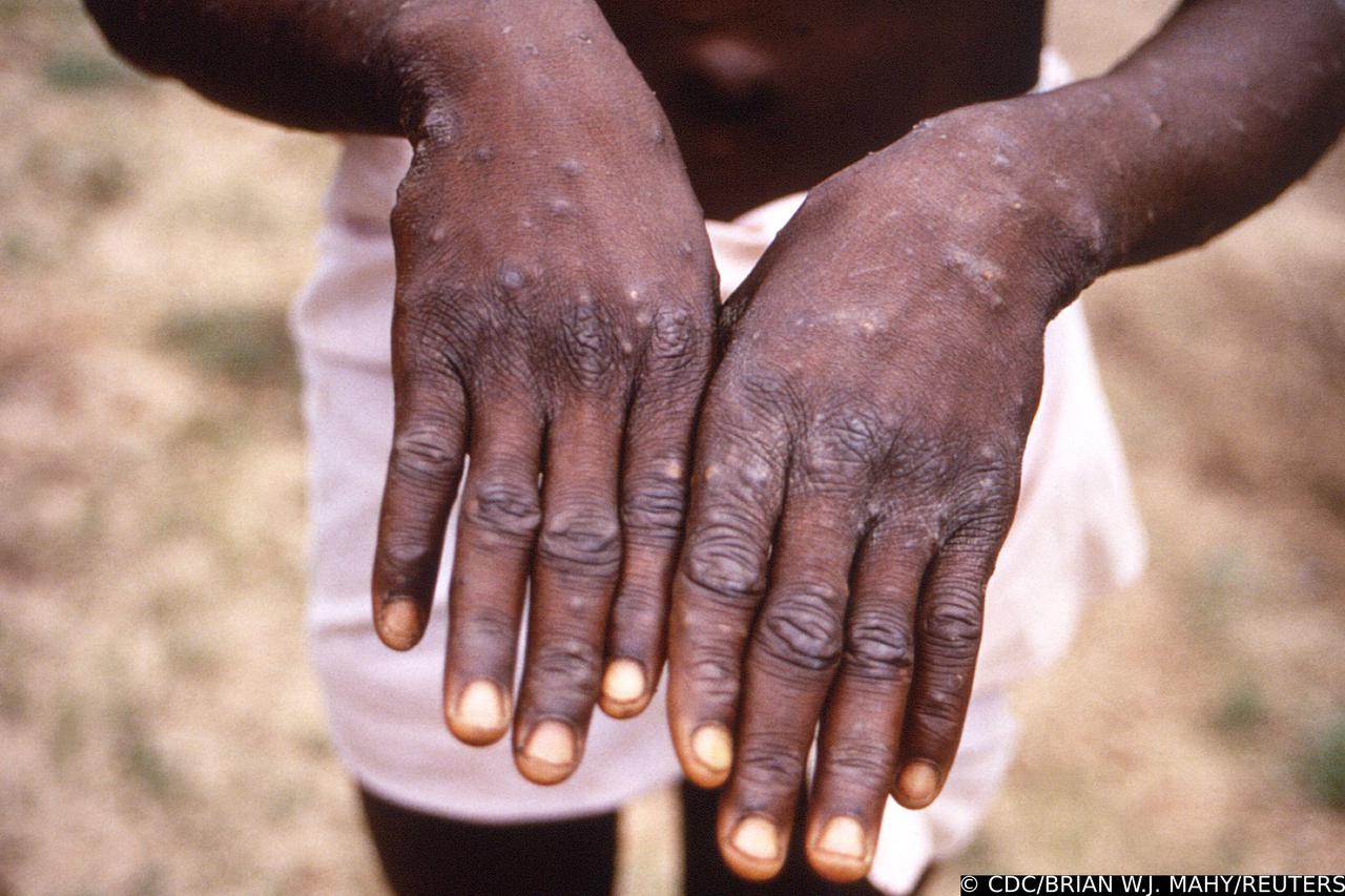 A CDC image shows a rash on a monkeypox patient