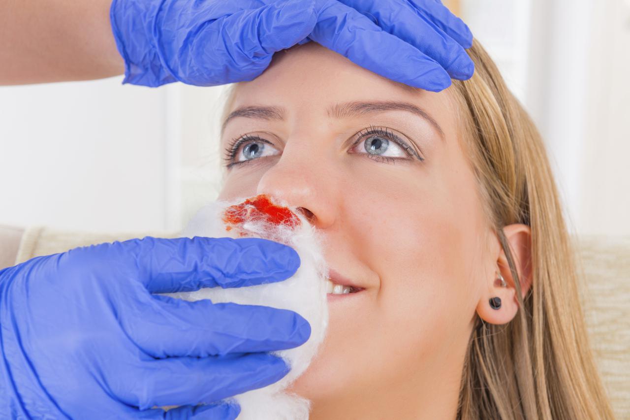 Krvarenje iz nosa