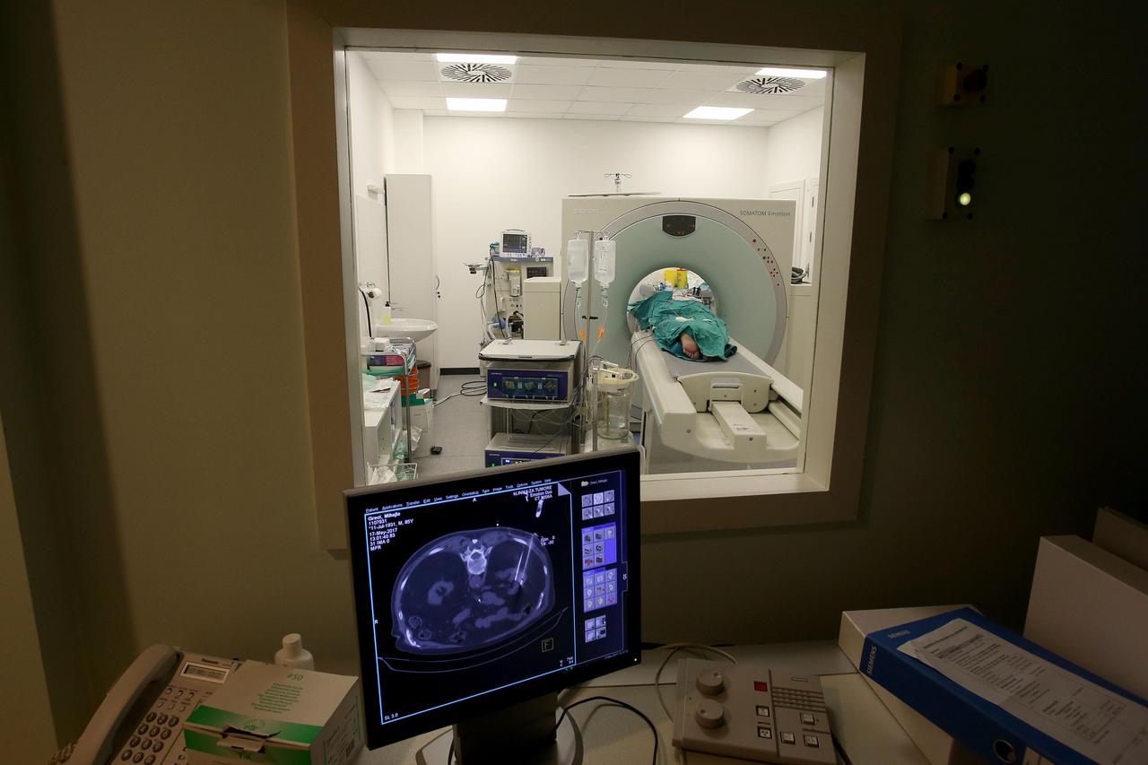 Zagreb: Operacija tumora uz pomo? radiofrekvencije u Klinici za tumore
