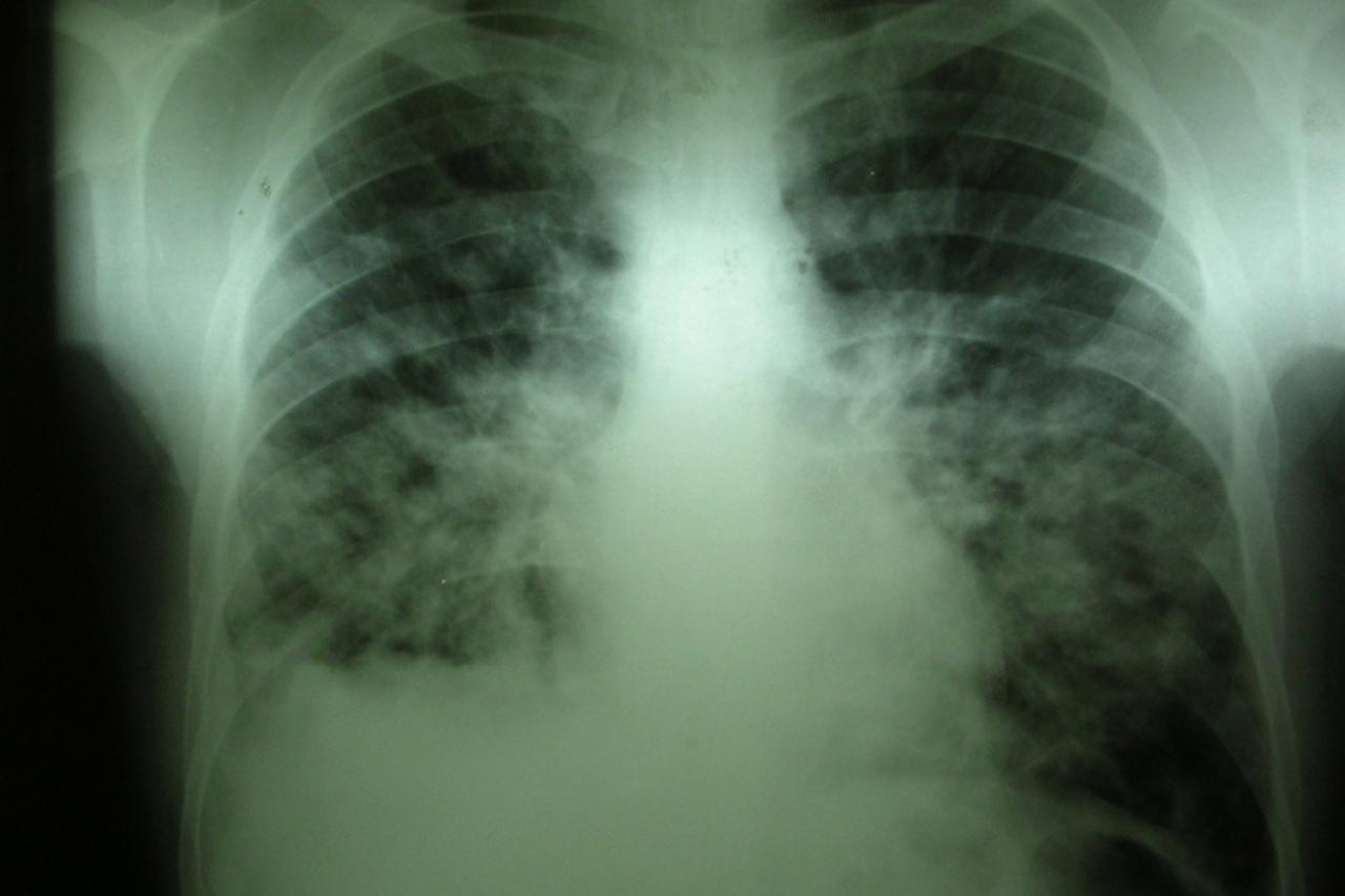 'tbc tuberkuloza'