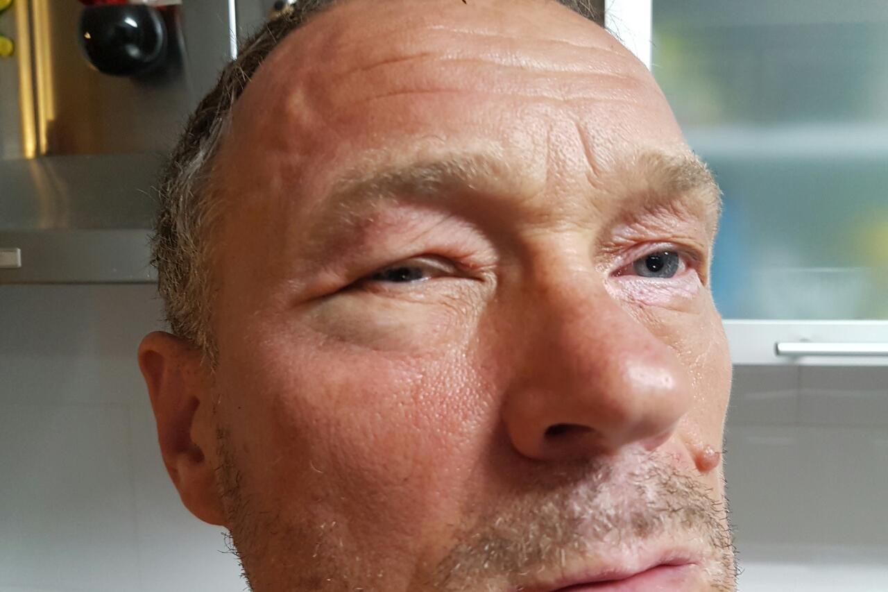 Mario Božurić sa masnicom ispod oka