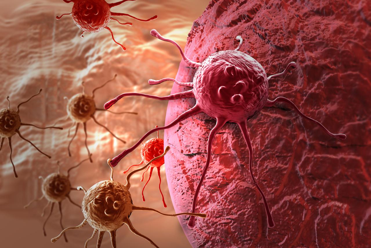 tumor
