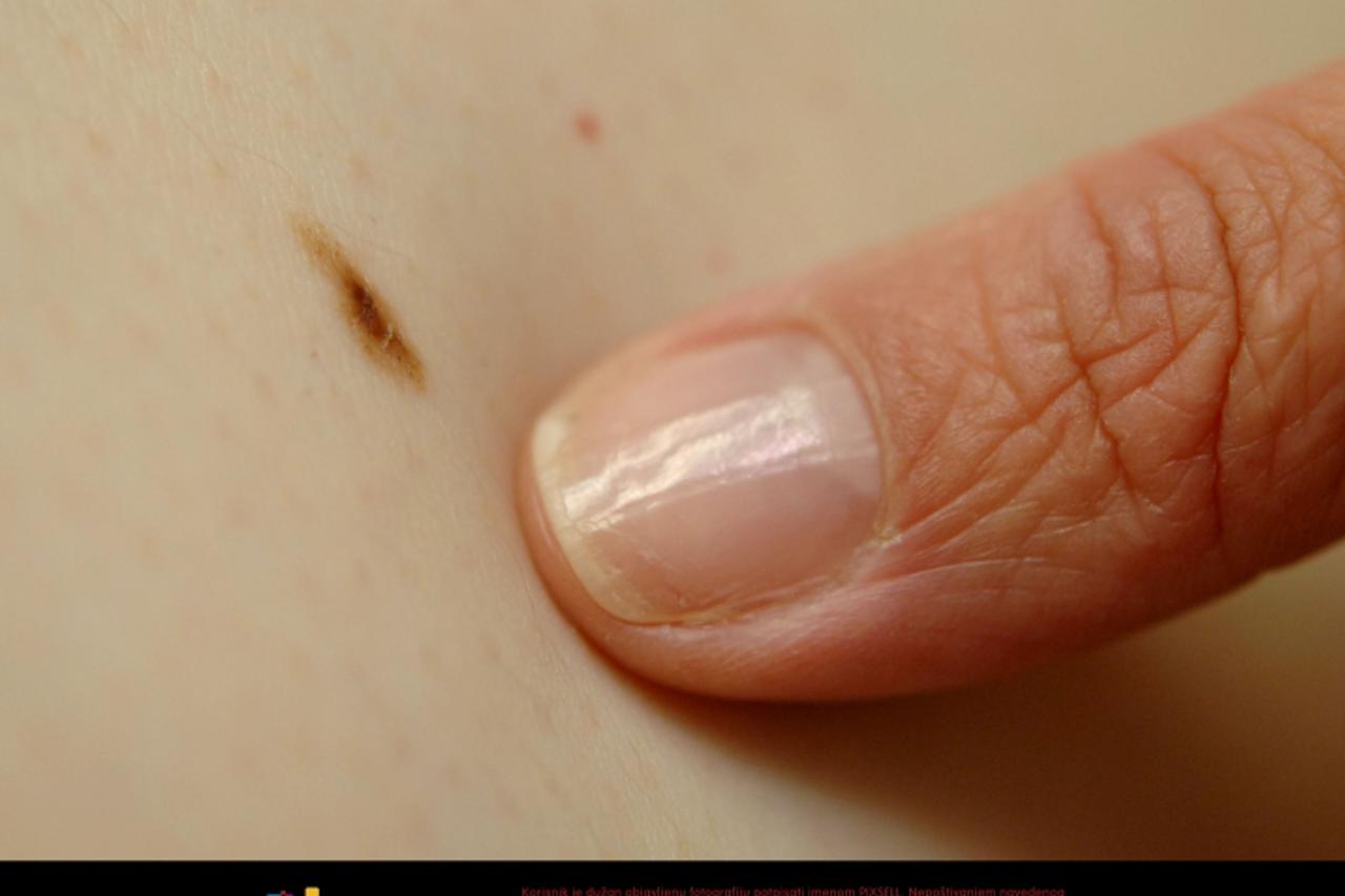 '13.5.2009., Zagreb - Ivana Manola iz poliklinike Vili pregledava madeze na pacjentici. Photo: Boris Scitar/Vecernji list'