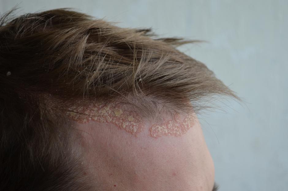 Psorijaza