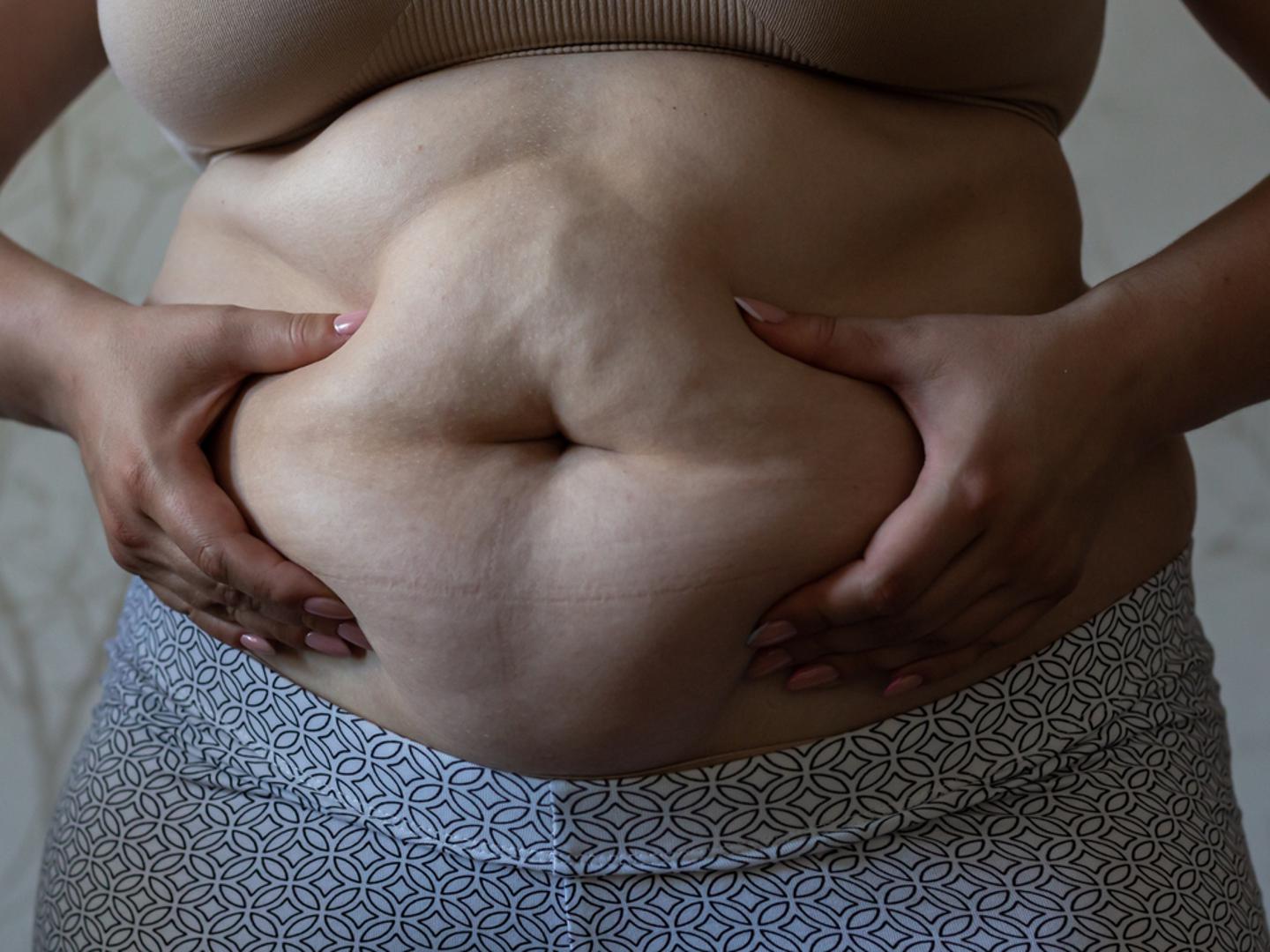 Povećanje tjelesne težine, osobito u području trbuha: Kortizol potiče nakupljanje masnog tkiva u predjelu abdomena, neovisno o prehrambenim navikama. Povećana masnoća na trbuhu često dolazi uz nadutost i usporenu probavu.