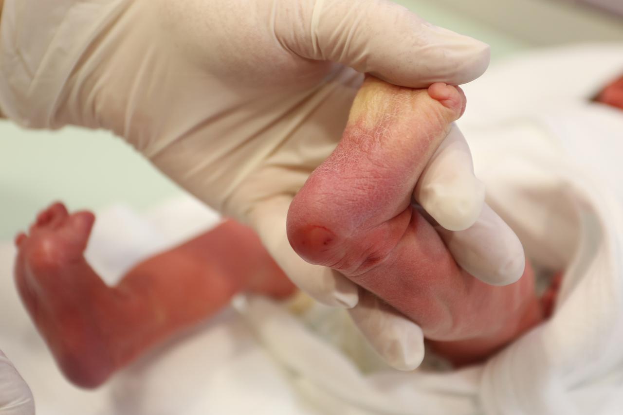 Vađenje krvi novorođenčetu iz pete