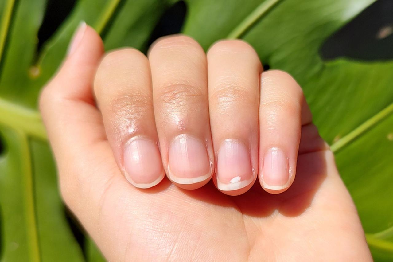 Bijele crte na noktima