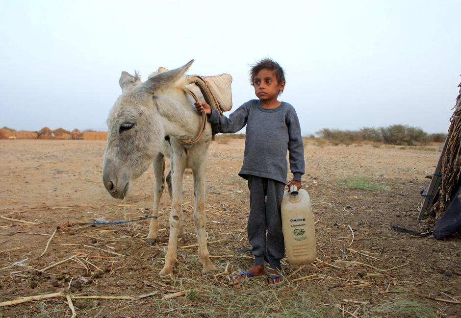 Yemeni boy fights malnutrition as hunger stalks nation's children