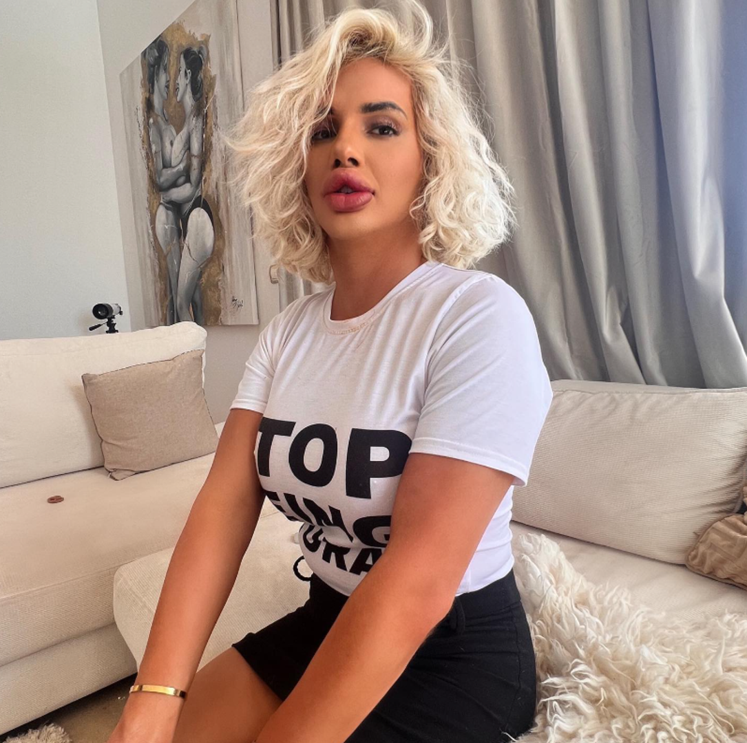 Vienna Würstel, koja živi u Španjolskoj poznata je po svojim golemim usnama.