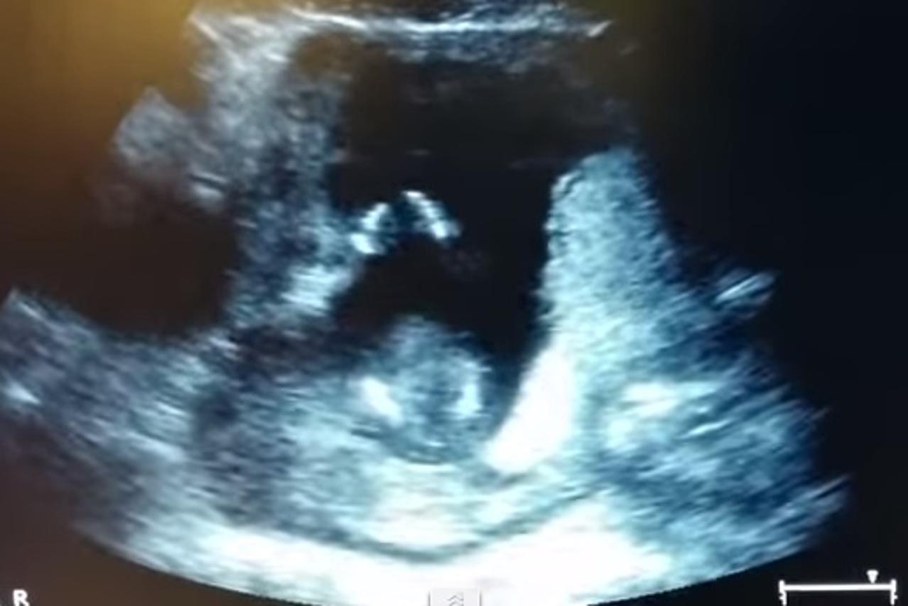 Ultrazvuk bebe koja plješće