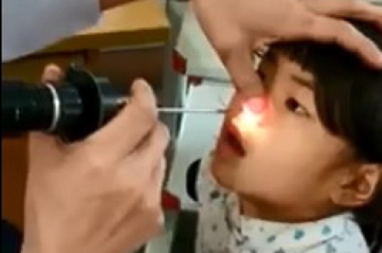 Liječnik djevojčici iz nosa izvukao crva