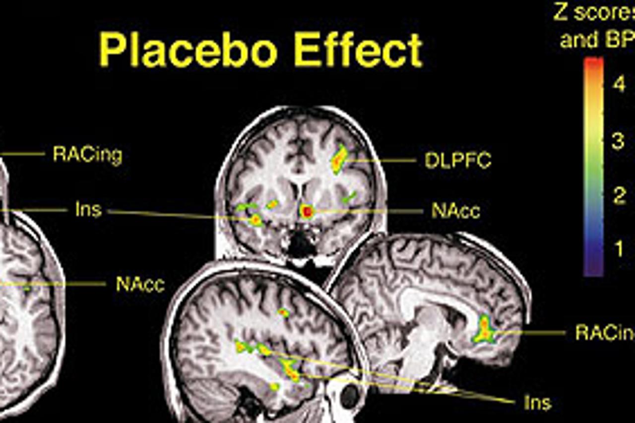 Placebo-učinak:Pacijent, uvjeren u djelotvornost terapije, ignorira svoje simptome ili ih slabije primjećuje bez značajnog poboljšanja zdravlja; tj. osjeća se bolje, ali nije zdraviji