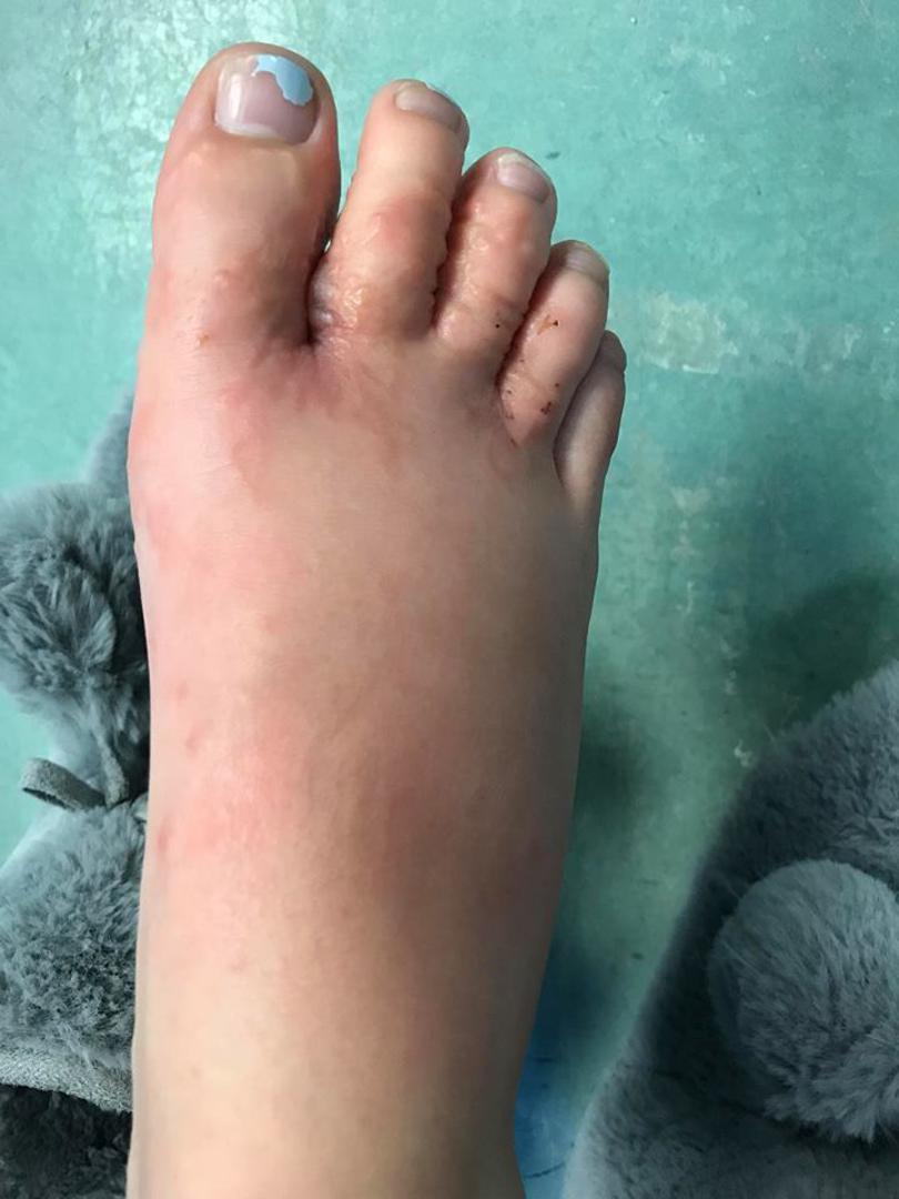 Paraziti s Kariba mogu ući u kožu ako dođu u kontakt s inficiranom površinom, a liječnik im je prepisao lijek nakon kojega im je stanje postalo bolje za tri dana. 