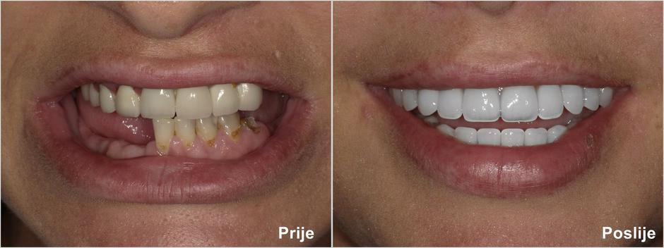 U samo 24 sata All-on-4 terapija vraća širok osmijeh vašem licu