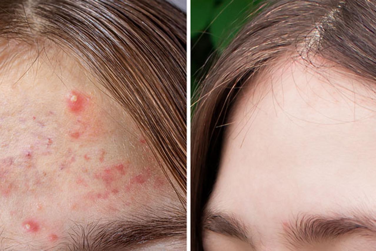 Izvanredno postignuće pomaže problematičnoj koži!