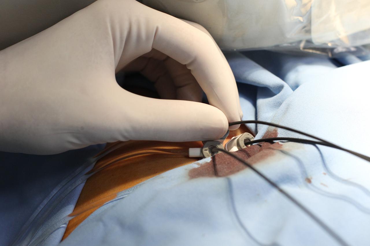 stent
