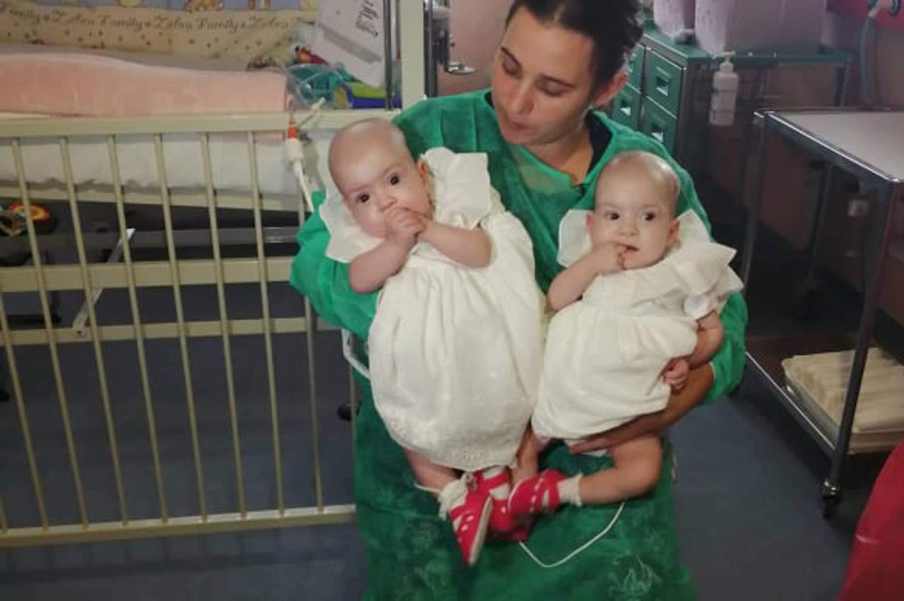 Razdvojene sijamske blizanke Valentina i Kristina Tambolaš