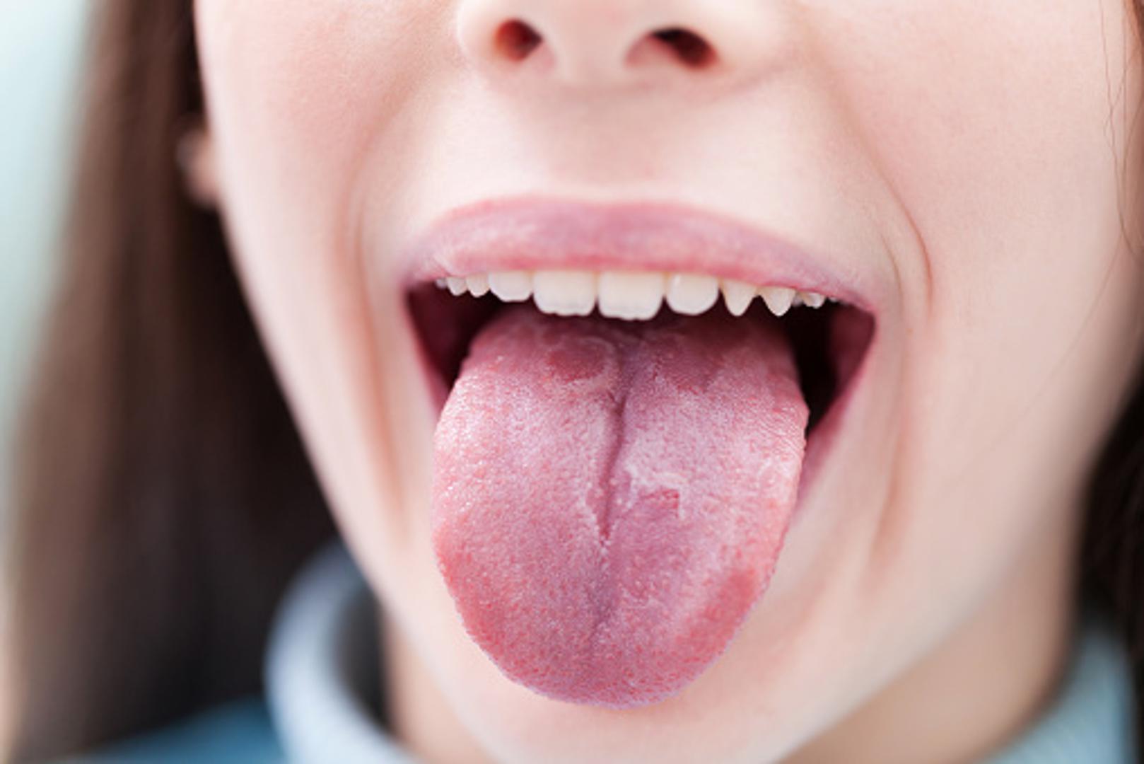 Crni jezik - Pretežno bezopasno stanje, ali neugodno za vidjeti. Uzroci mogu biti bakterije, gljivice, dehidracija, ispijanje previše kave...Ako potraje dulje od 10 dana, javite se liječniku 