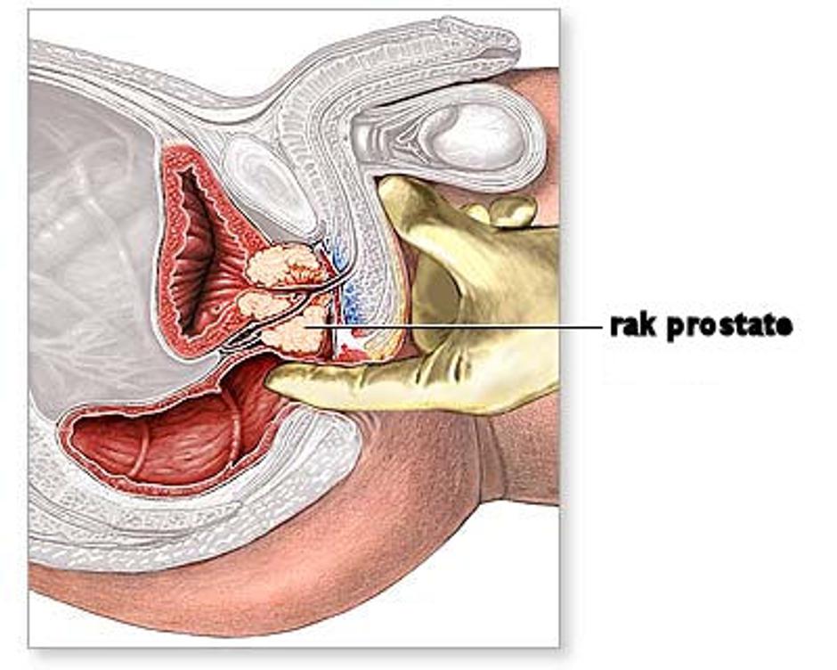 Prostata