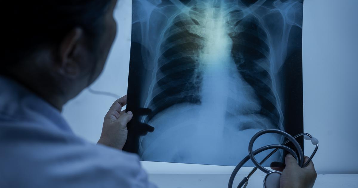 Znanstvenici otkrivaju razlog koji uvelike povećava rizik od raka pluća: Nepušači su najviše izloženi riziku