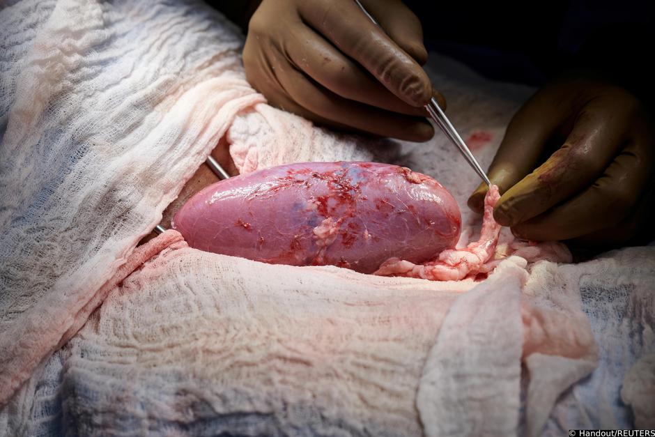 New advance in kidney transplants