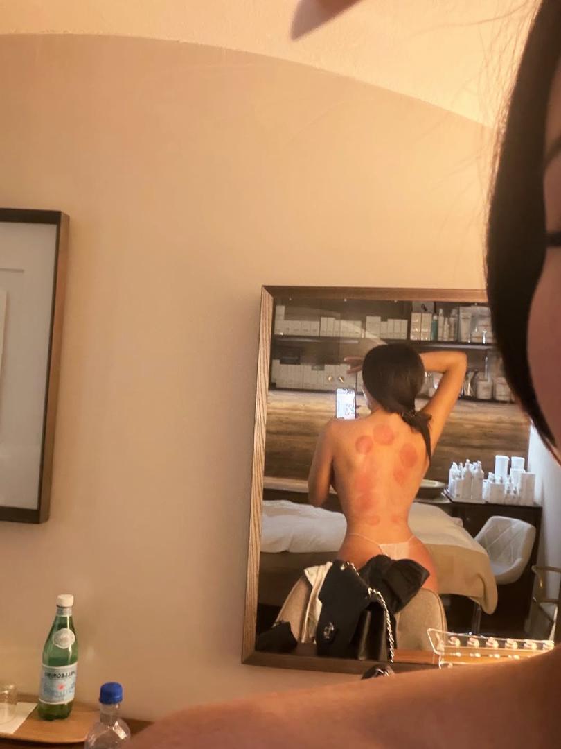 Svaka njezina objava izaziva brojne reakcije, a sada je privukla pozornost fotografijom na kojoj je pozirala u toplesu, pritom otkrivši tragove cupping terapije. Fotografija je brzo prikupila tisuće lajkova i komentara obožavatelja koji su hvalili njezin izgled.