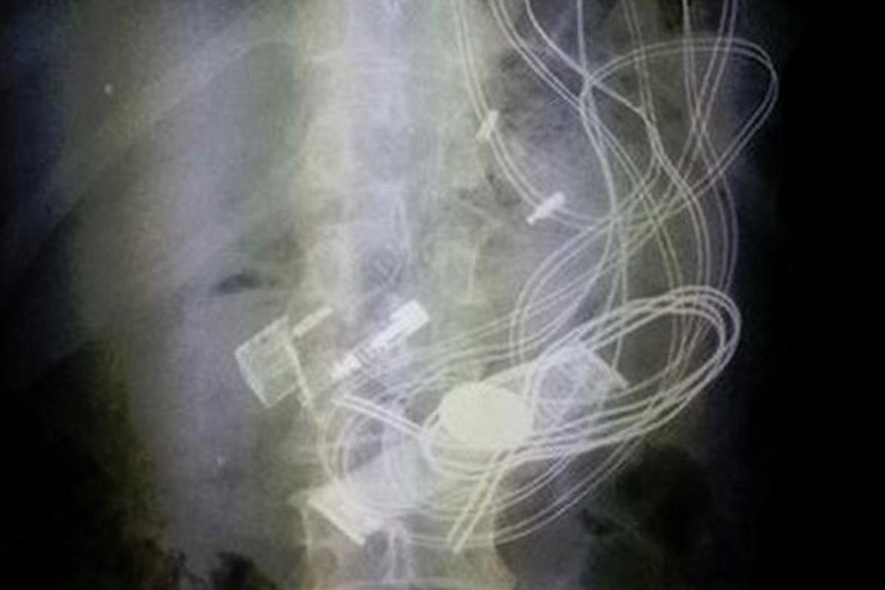 rengenska snimka,gutanje