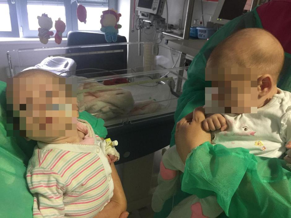 Sijamske blizanke Kristina i Valentina