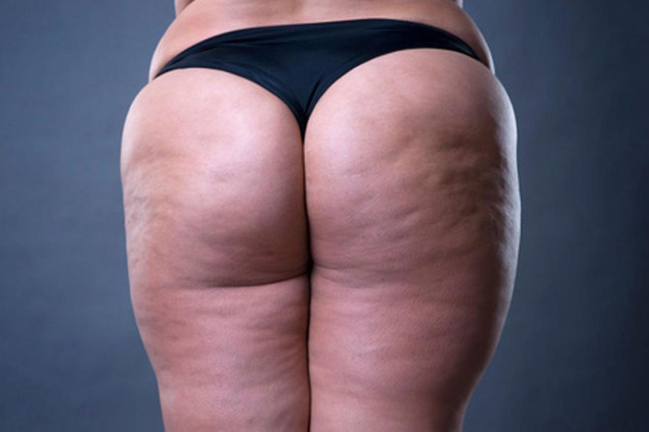 Kako sam pobijedila omraženi celulit