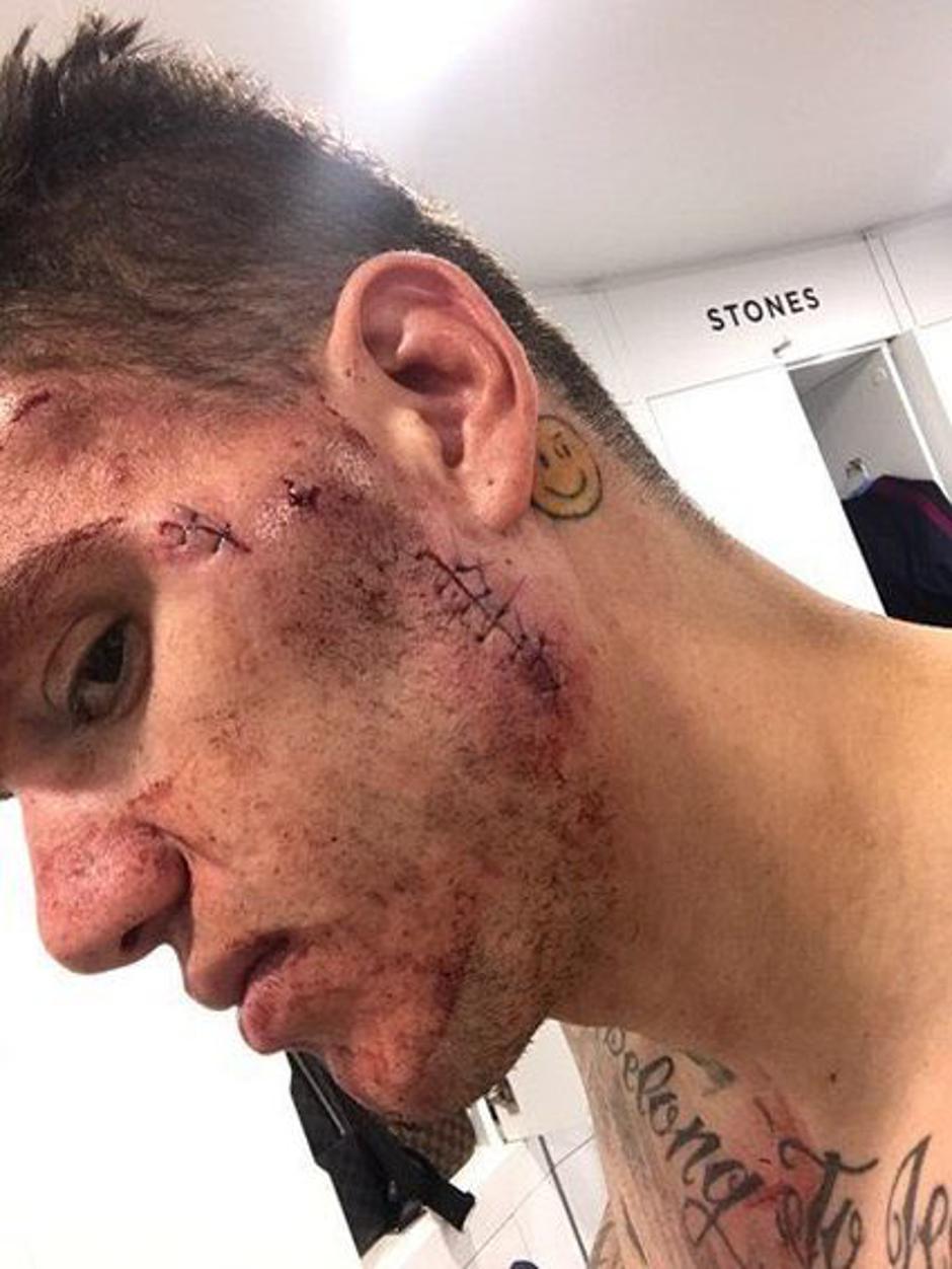 Ederson