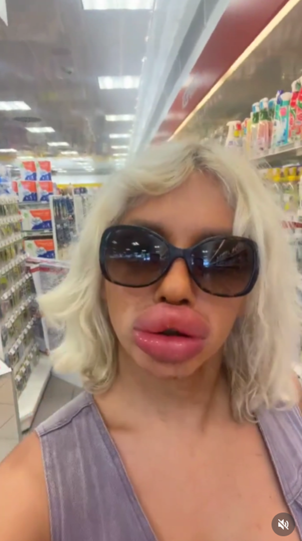 Vienna je prošla kroz brojne operacije i kozmetičke zahvate kako bi postigla svoj jedinstveni izgled, uključujući povećanje grudi, podizanje usana, podizanje očiju, BBL (Brazilsku operaciju podizanja stražnjice), a doktori su joj ugradili i i implantate za obraze i bradu.