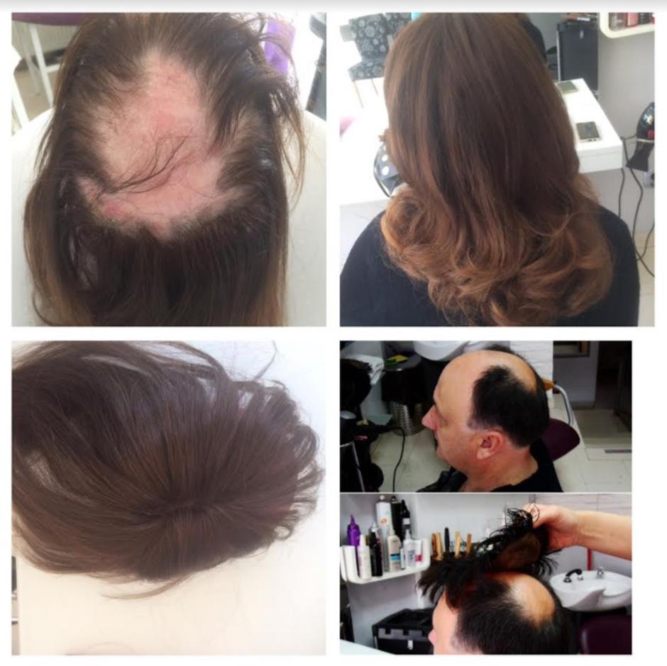 Alternativna transplantacija kose