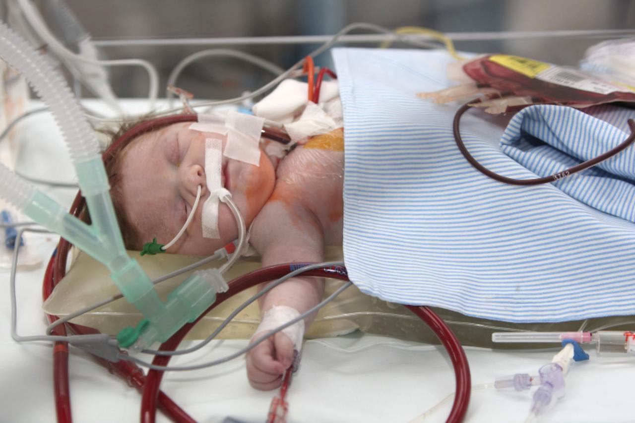 \'23.03.2010.,Zagreb,Hrvatska,KBC Zagreb,Kispaticeva 12 - Bolnica Rebro - Klinika za anesteziologiju,reanimatologiju i intenzivno lijecenje.Novorodjence prikljuceno na takozvani ECMO aparat koji sluzi