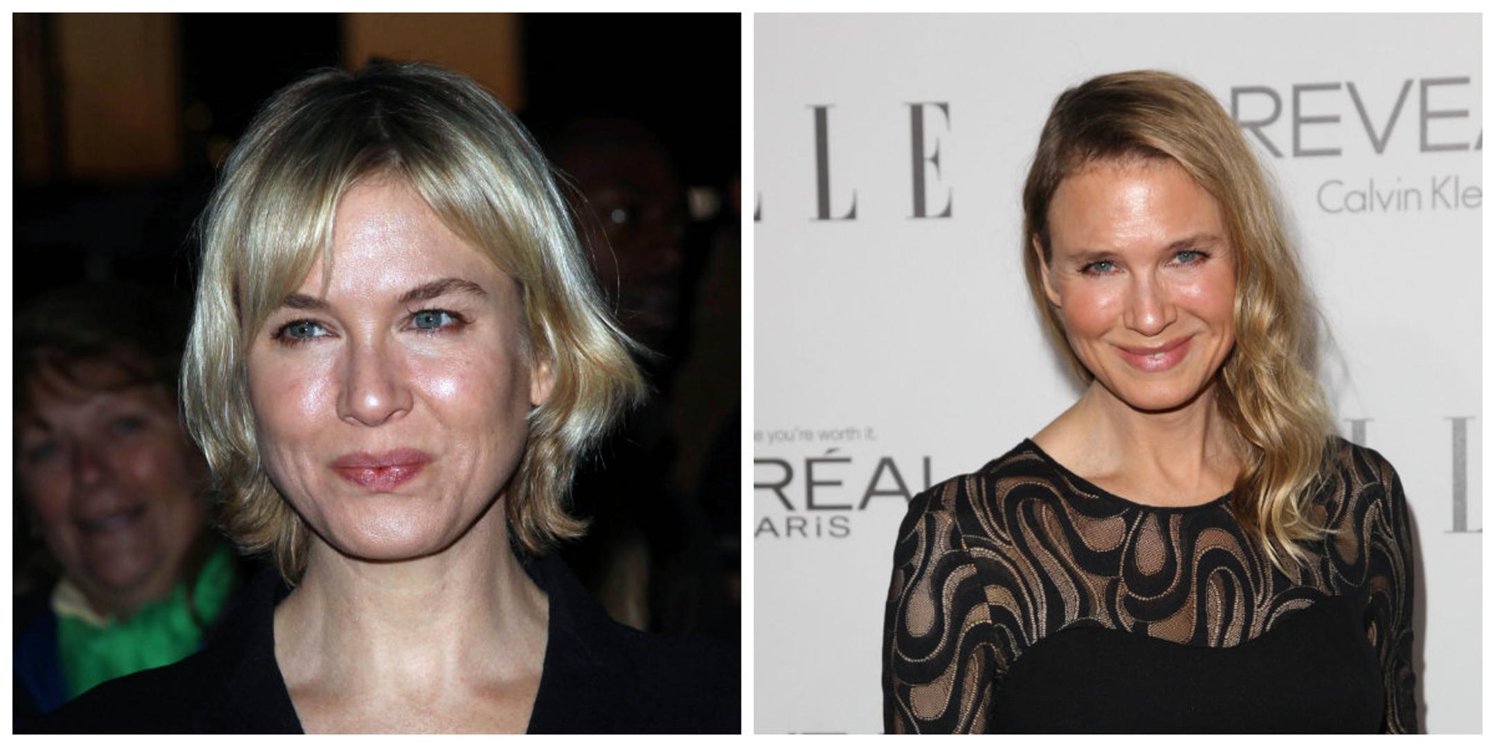 Jabučasto lice bilo je zaštitni znak glumice Renee Zellweger, a onda ga je uništila i sasvim izmijenila pretjeranim korištenjem botoksa.