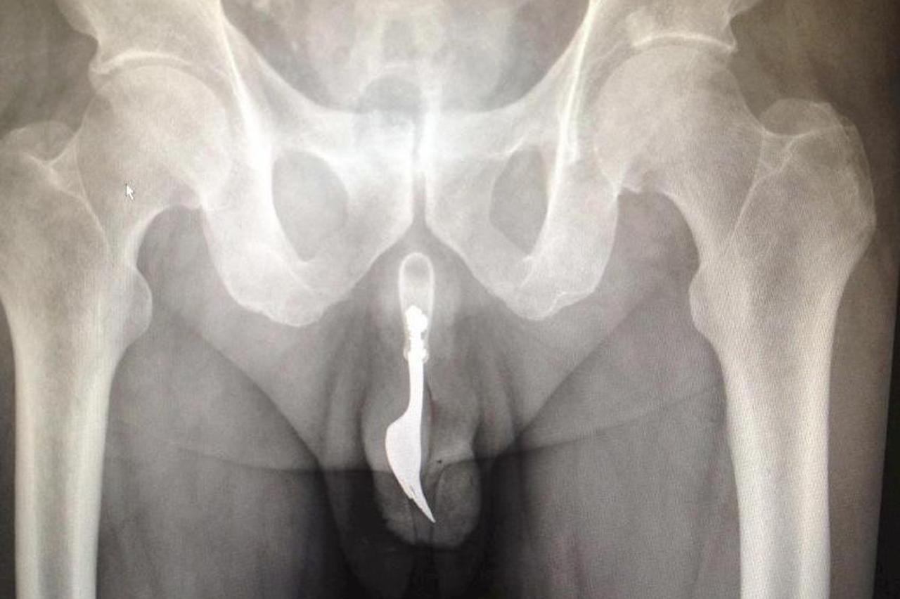 vilica penis