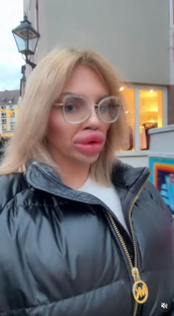 U jednom intervjuu Vienna je kazala: „Imam najveće usne na svijetu, ali neću stati tu – želim ih još veće.”