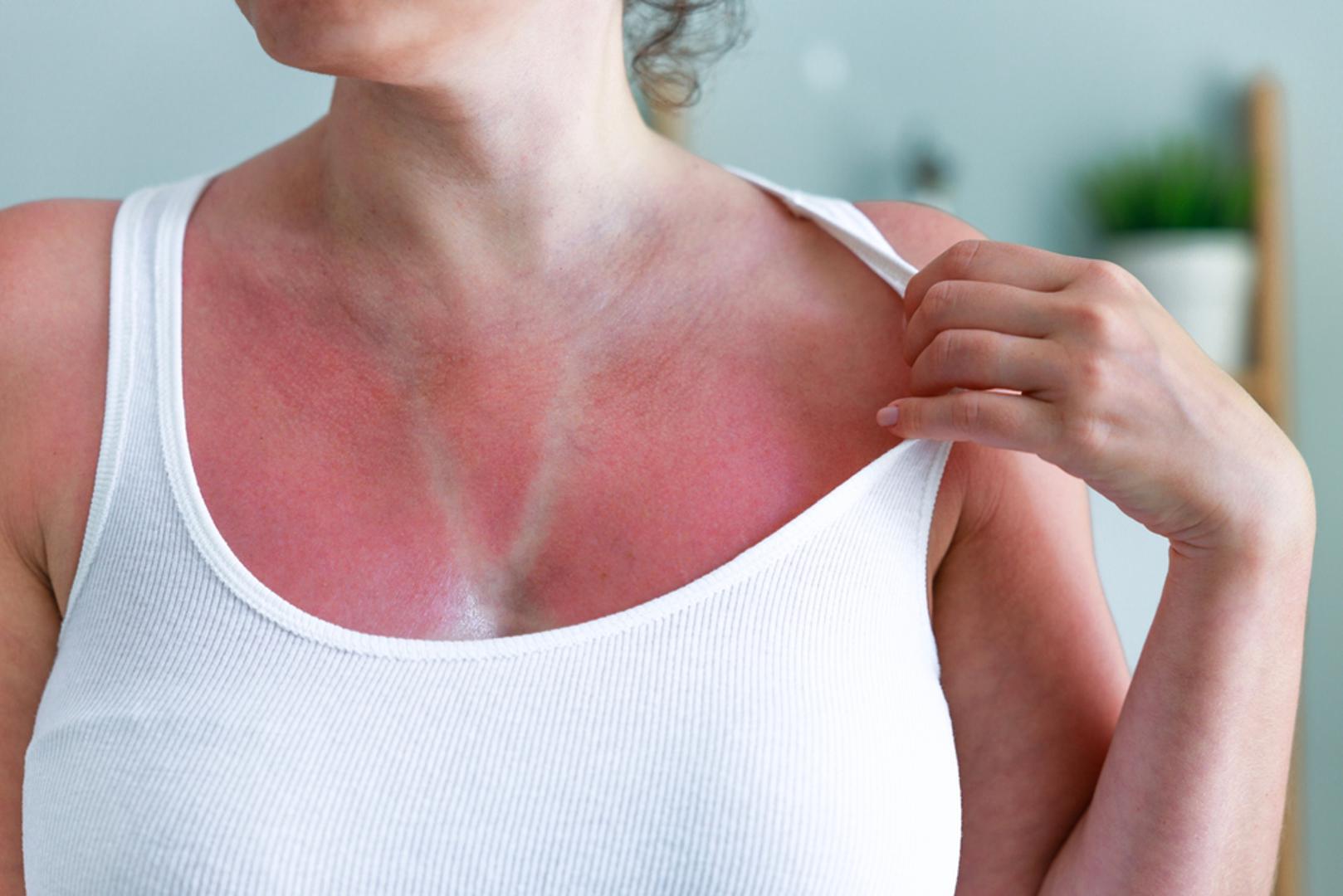 Sunčane opekline česta su ljetna neugodnost, osobito nakon prekomjernog izlaganja suncu bez adekvatne zaštite. Koža postaje crvena, osjetljiva na dodir, a u težim slučajevima pojavljuju se mjehurići i ljuštenje. Iako je najbolja zaštita prevencija, kada do opeklina ipak dođe, prirodni pripravci kod blagih i umjerenih opeklina mogu značajno ublažiti simptome. 