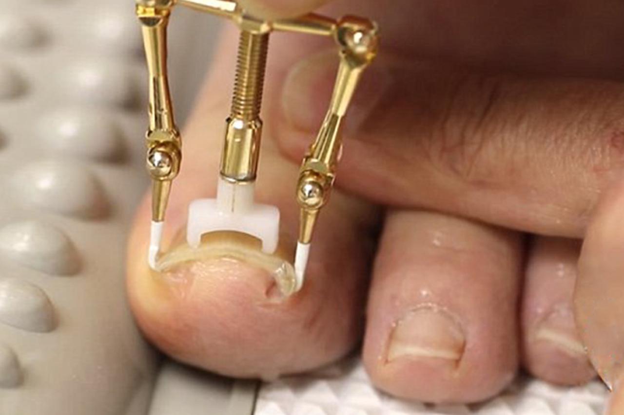 Onycho correct aplikator