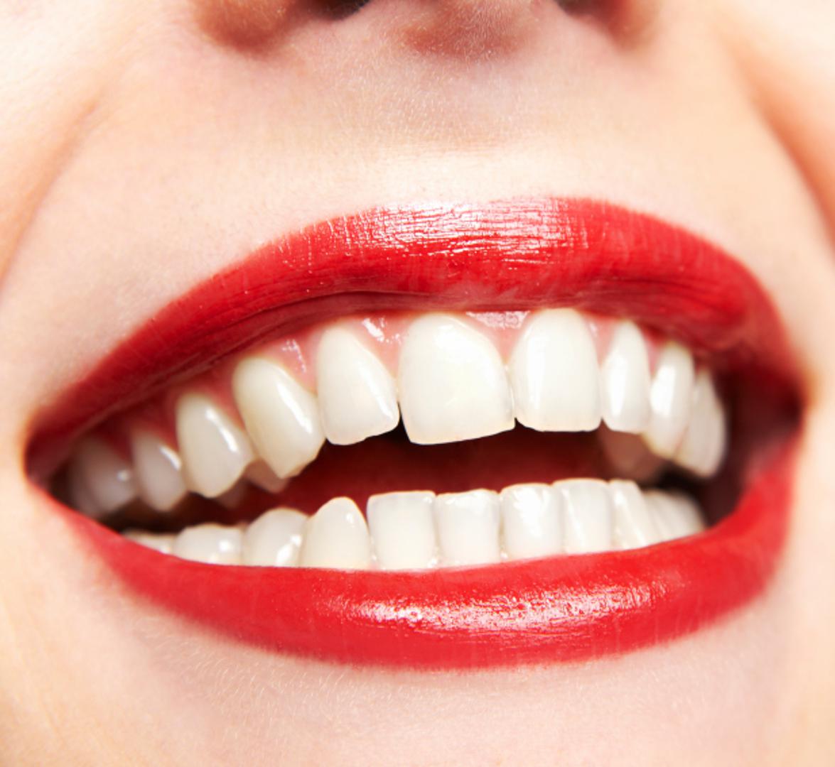 Zubi su ono što će većina ljudi prvo primjetiti na vama. Upravo stoga sve češće mnogi teže "holivudskim osmijesima" jer žuti, prljavi zubi mogu itekako narušiti cijeli dojam.