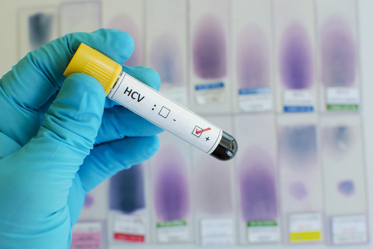 Hepatitis