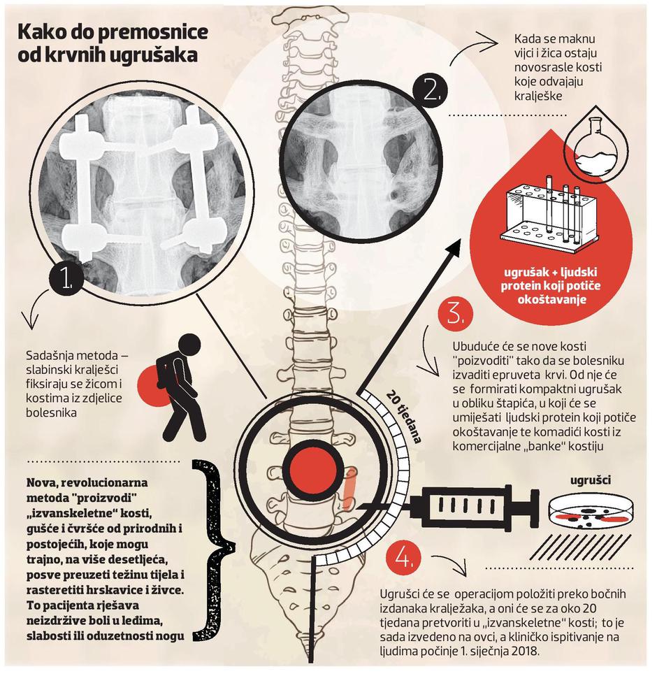Kako do premosnice od krvnih ugrušaka