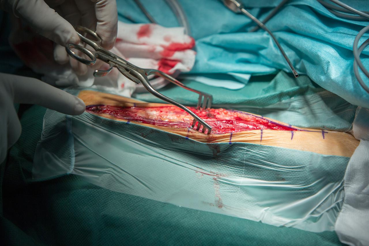 Neurološka operacija/Ilustracija