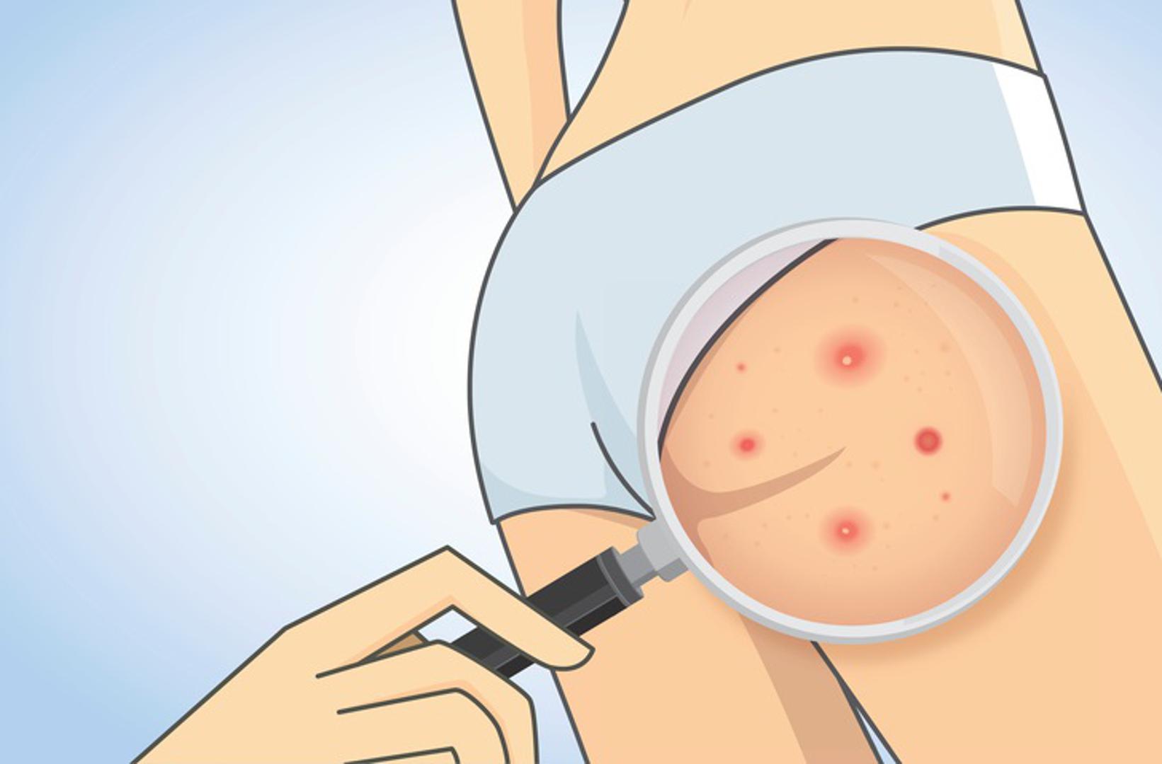 8. Čisti kožu od prištića

