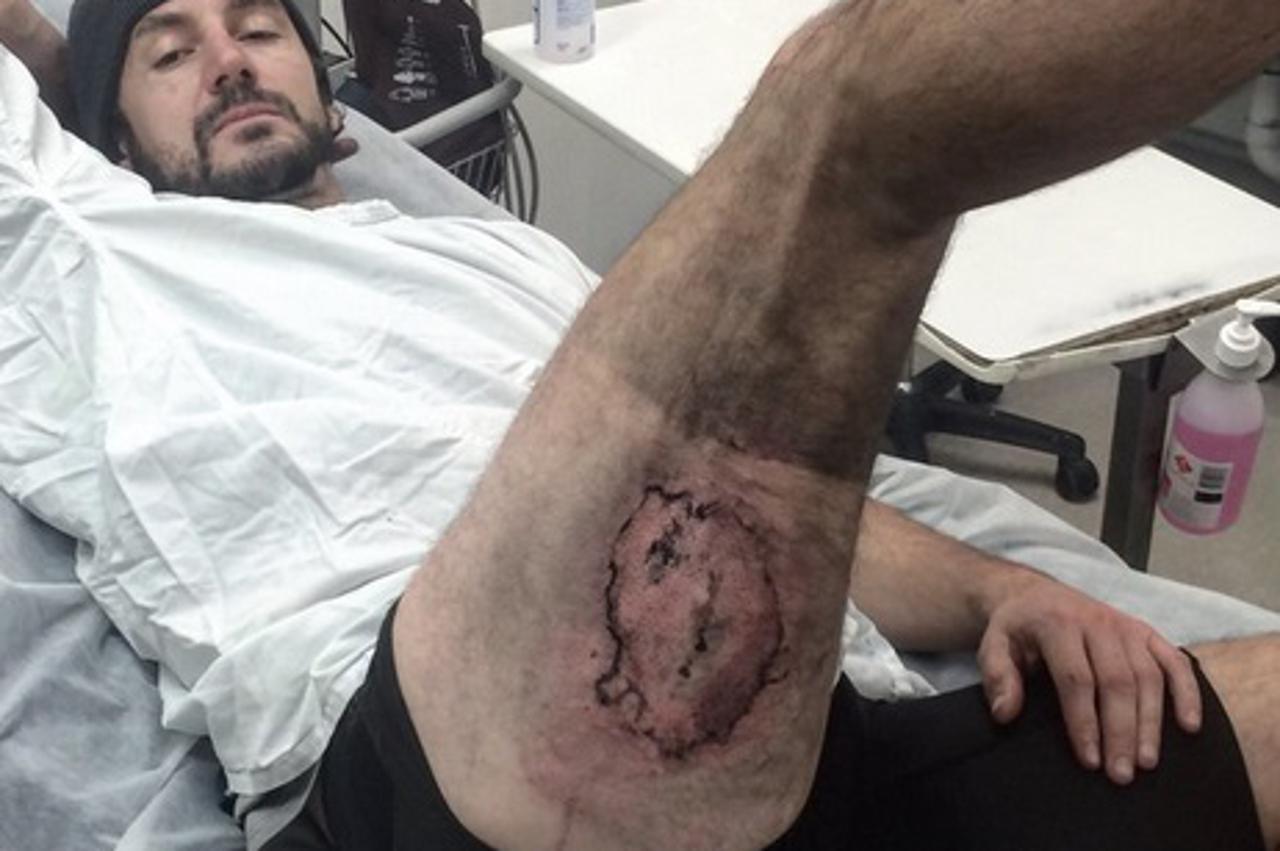 Opekotina od iPhonea