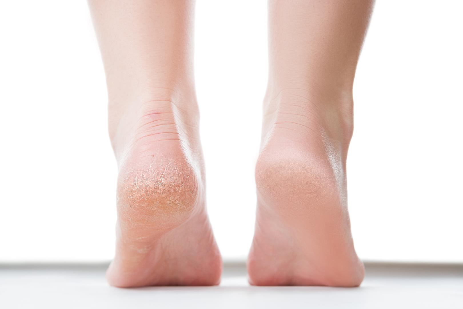 S dolaskom toplijeg vremena, mnogi imaju sve više problema sa zadebljanom i suhom kožom na stopalima.