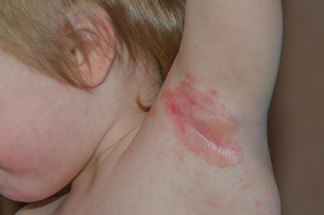 Mala djevojčica boluje od izuzetno rijetke bolesti