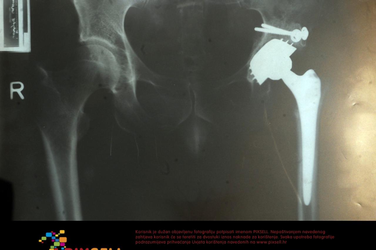 '29.06.2011., Split - Tomislav Buljubasic (62), poduzetnik, vlasnik Taho ST tvrtke, prvi je Hrvat koji je usjesno produzio nogu. Tomislav je imao iscasen kuk i kracu nogu zbog cega je trpio bolove cij