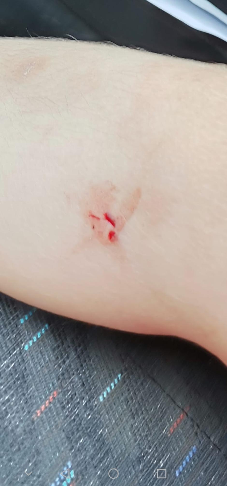 Zmija ugrizla dječaka