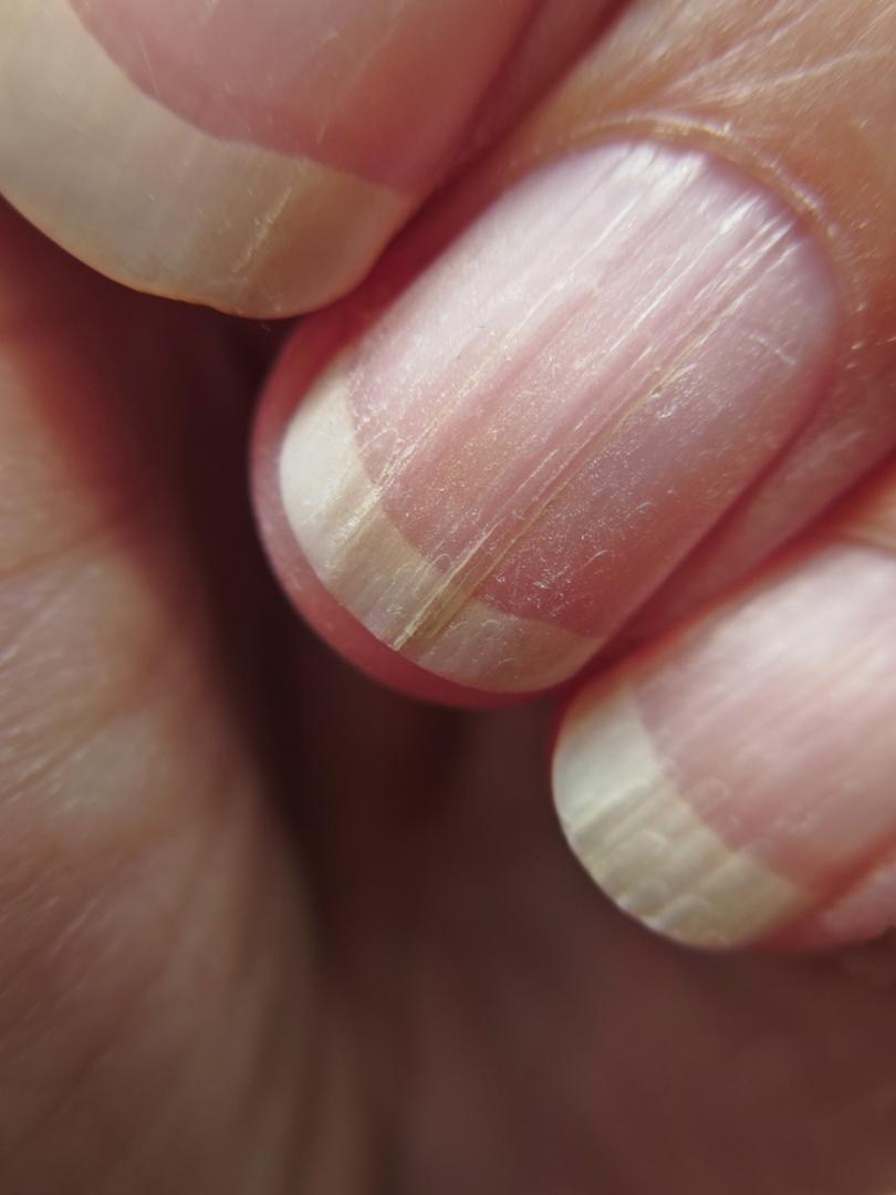 Vertikalne linije na noktima u većini slučajeva potpuno su normalne i pojavljuju se s godinama, slično kao bore na koži. Najčešće su znak prirodnog starenja nokta i nisu razlog za brigu. Mogu biti i izraženije ako su nokti suhi ili ako tijelu nedostaje hidratacije.