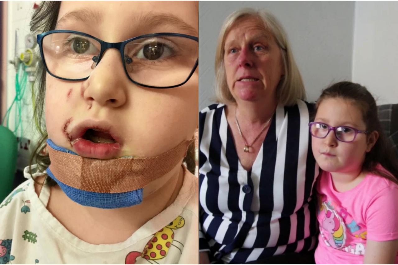 Pas izgrizao djevojčicu